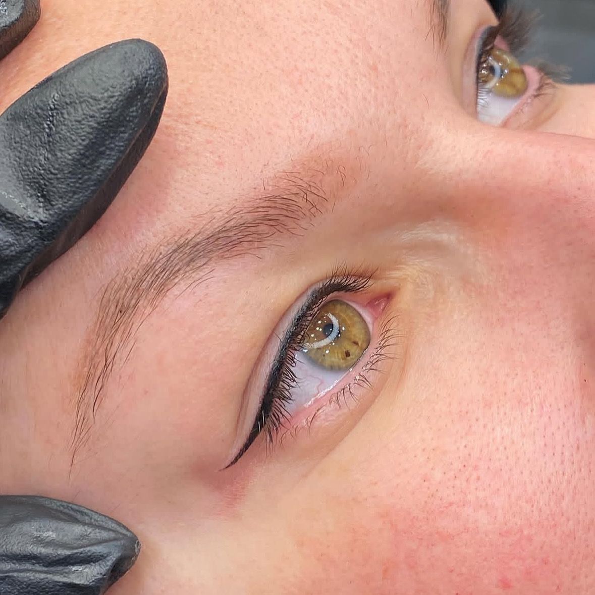 Tedavi Öncesi Sonrası